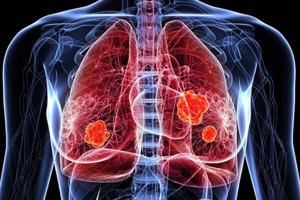 Early Signs of Lung Cancer_1 Early Signs of Lung Cancer_1