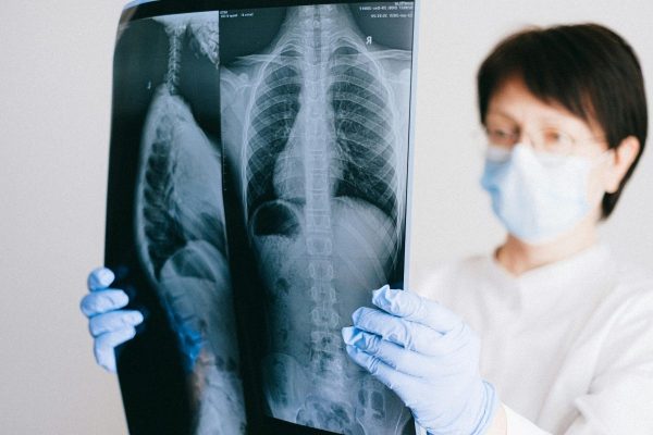 Early Signs of Lung Cancer_2 Early Signs of Lung Cancer_2